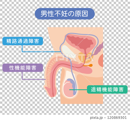 男性不妊の原因　不妊症　生殖医療 120869301