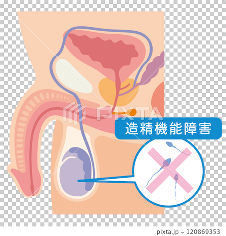 造精機能障害 男性不妊の原因 不妊症 生殖医療 造精機能障害 男性不妊の原因 不妊症 生殖医療 120869353