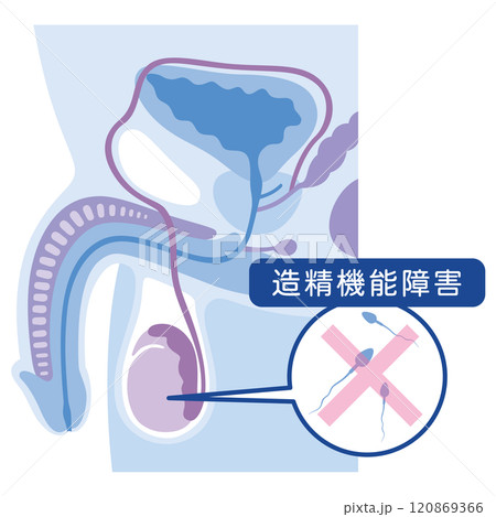 造精機能障害 男性不妊の原因 不妊症 生殖医療 造精機能障害 男性不妊の原因 不妊症 生殖医療 120869366