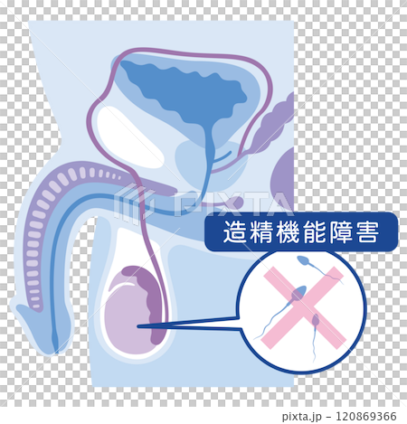 造精機能障害 男性不妊の原因 不妊症 生殖医療 造精機能障害 男性不妊の原因 不妊症 生殖医療 120869366