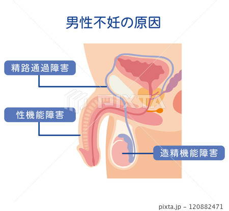 男性不妊の原因 不妊症 生殖医療 男性不妊の原因 不妊症 生殖医療 120882471