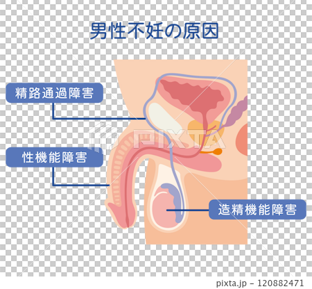 男性不妊の原因 不妊症 生殖医療 男性不妊の原因 不妊症 生殖医療 120882471