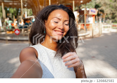 Happy woman with vitiligo skin problem taking 120882581