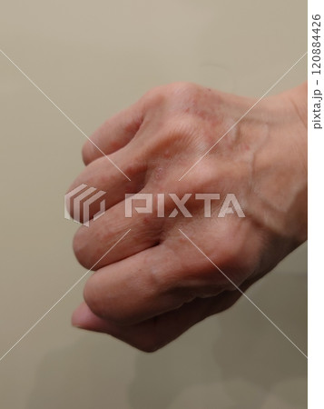 湿疹の出た手の甲 120884426