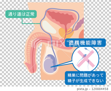 Spermatogenesis disorder, causes of male infertility, infertility, reproductive medicine 120884458