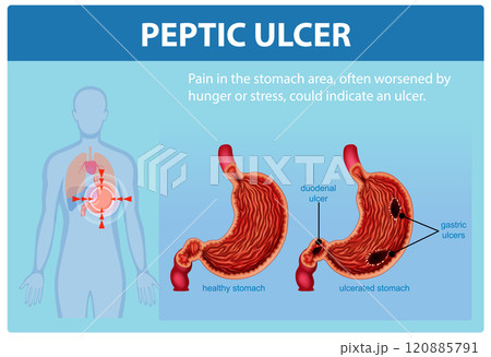 Understanding Peptic Ulcers and Symptoms 120885791