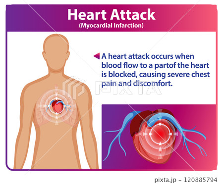 Understanding Heart Attack Symptoms and Causes 120885794