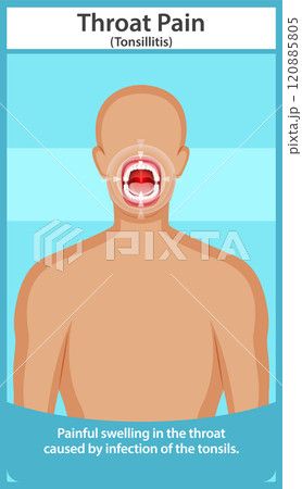 Illustration of Throat Pain and Tonsillitis Illustration of Throat Pain and Tonsillitis 120885805