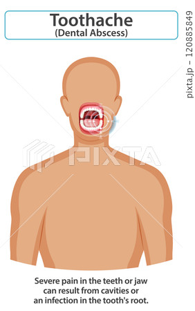 Understanding Toothache and Dental Abscess 120885849