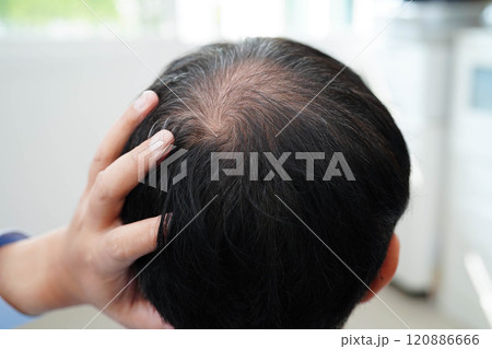 Bald head in man, hair loss treatment health problem. Bald head in man, hair loss treatment health problem. 120886666