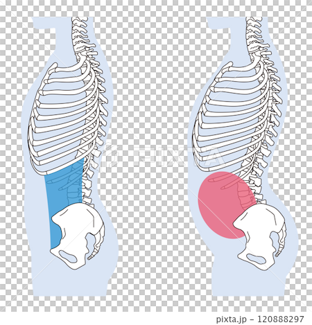 肋骨の開き 反り腰 正しい姿勢と反り腰の姿勢 肋骨の開き 反り腰 正しい姿勢と反り腰の姿勢 120888297