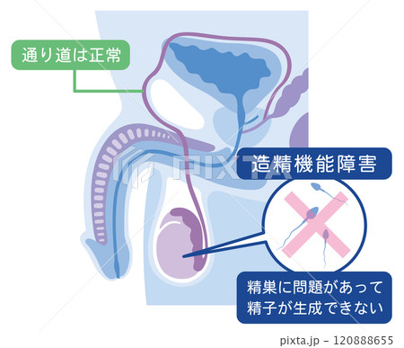 造精機能障害 男性不妊の原因 不妊症 生殖医療 造精機能障害 男性不妊の原因 不妊症 生殖医療 120888655