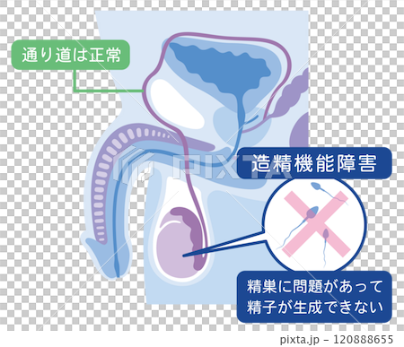 造精機能障害 男性不妊の原因 不妊症 生殖医療 造精機能障害 男性不妊の原因 不妊症 生殖医療 120888655