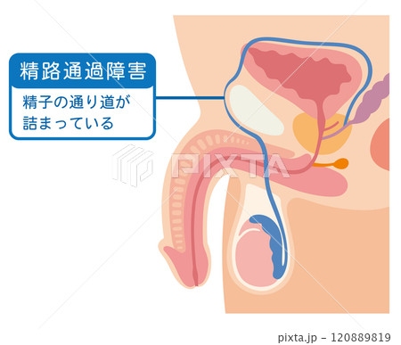 精路通過障害　精子の通り道が詰まっている 120889819