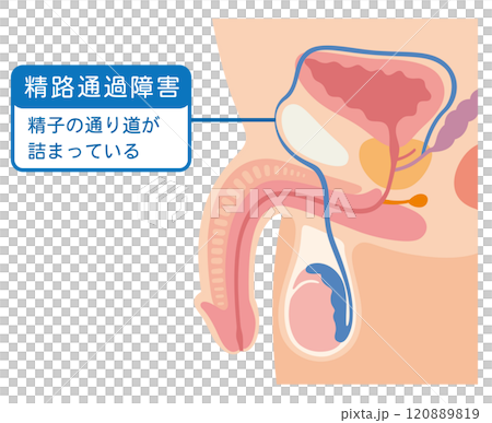 精路通過障害　精子の通り道が詰まっている 120889819