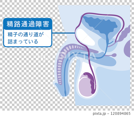 精路通過障害　精子の通り道が詰まっている　男性不妊 120894865