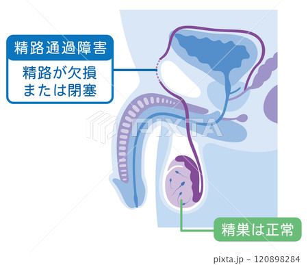 精路通過障害　精路が欠損または閉塞　男性不妊 120898284