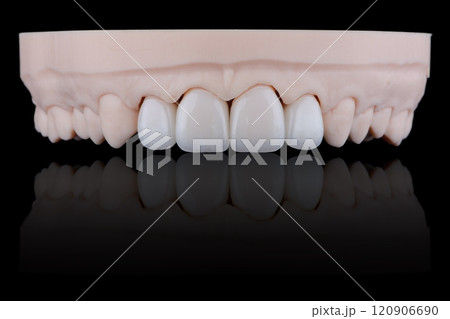 Four dental ultra-thin ceramic veneers in bleach color for fixation to frontal teeth of upper jaw. 120906690