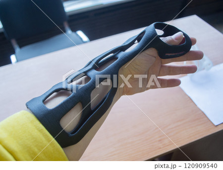 Hand splint corset prosthesis printed on 3D printer from molten black plastic powder on hand. Medical orthosis fixator plastic overlay created on 3D printer. New modern medical 3D printing technology, 120909540