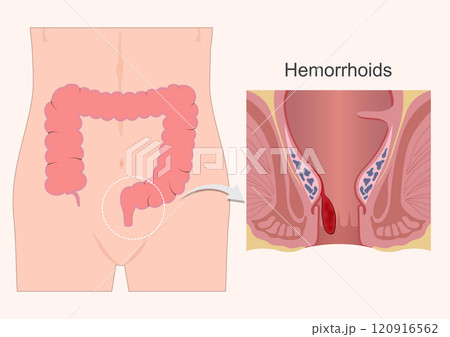 Hemorrhoids or piles are anal cushions. 120916562