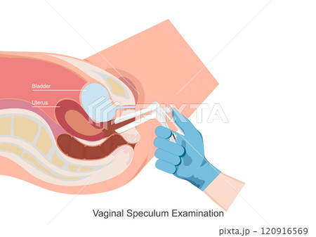 Vaginal Speculum Examination. Vaginal Speculum Examination. 120916569