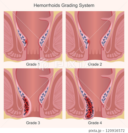 Hemorrhoids are categorized into 4 grades. Hemorrhoids are categorized into 4 grades. 120916572