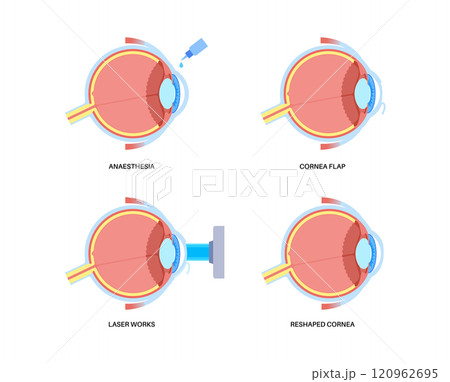 LASIK eye surgery LASIK eye surgery 120962695