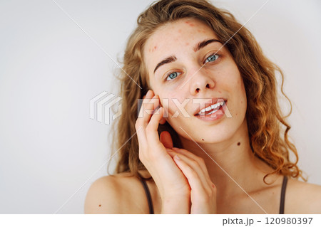 Close-up of a cute woman with problem skin looking in the mirror. Dermatology concept, allergy. Close-up of a cute woman with problem skin looking in the mirror. Dermatology concept, allergy. 120980397