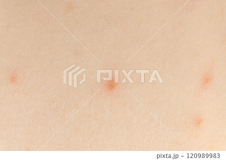 Macro skin with chickenpox, vesicles at different stages. 120989983