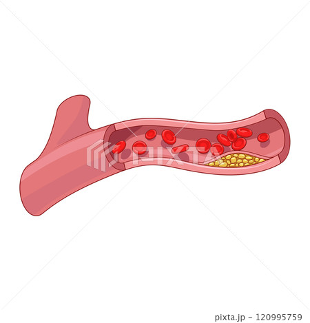 Blood vessel and cholesterol plaque vector Blood vessel and cholesterol plaque vector 120995759