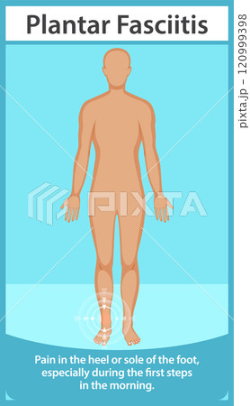 Understanding Plantar Fasciitis Pain 120999398