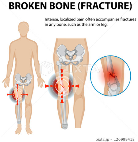 Understanding Bone Fractures and Pain Understanding Bone Fractures and Pain 120999418