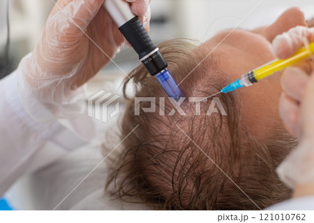 Trichologist doing man improve hair growth procedure, dermapen microneedling, vitamin injections Trichologist doing man improve hair growth procedure, dermapen microneedling, vitamin injections 121010762