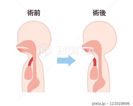 喉頭癌の術前術後の気管のイラスト 喉頭癌の術前術後の気管のイラスト 121028606