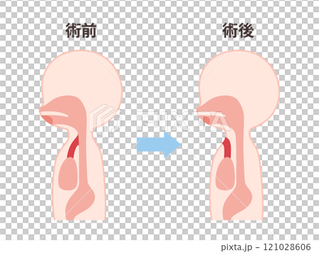 喉頭癌の術前術後の気管のイラスト 喉頭癌の術前術後の気管のイラスト 121028606