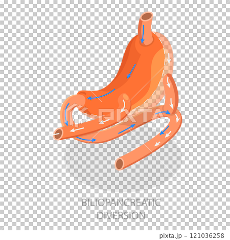 3D Isometric Flat  Illustration of Types Of Bariatric Surgery. Item 1 121036258