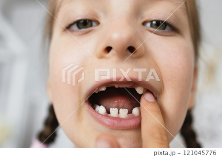 Close-up portrait of Caucasian girl with braided hair showing her missing baby teeth. Young child experiencing natural tooth loss in cozy home setting. 121045776