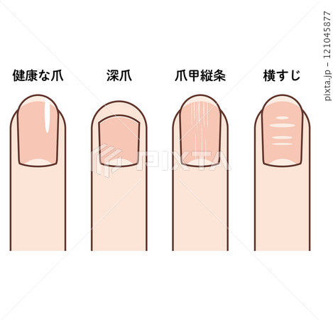 手の指先のイラスト(健康な爪、深爪、爪甲縦条、波板状爪) 手の指先のイラスト(健康な爪、深爪、爪甲縦条、波板状爪) 121045877