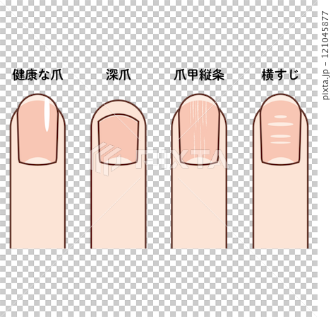手の指先のイラスト(健康な爪、深爪、爪甲縦条、波板状爪) 手の指先のイラスト(健康な爪、深爪、爪甲縦条、波板状爪) 121045877