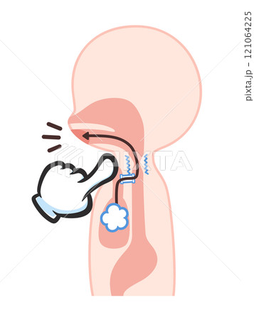 喉頭癌の手術後のシャント発声のイラスト 121064225
