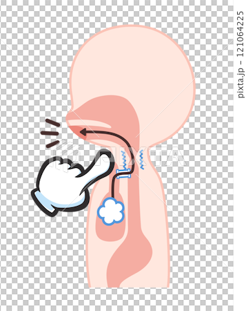 喉頭癌の手術後のシャント発声のイラスト 121064225