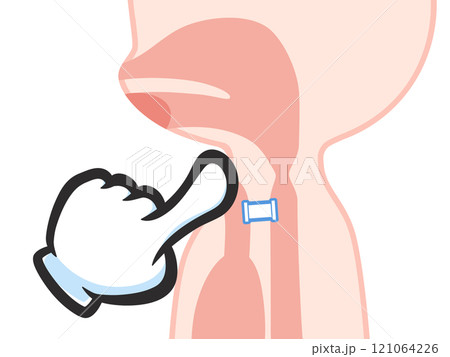 喉頭癌の手術後のシャント発声のイラスト 121064226
