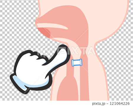 喉頭癌の手術後のシャント発声のイラスト 121064226