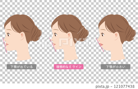 Mandibular prognathism, E-line, profile, jaw Mandibular prognathism, E-line, profile, jaw 121077438