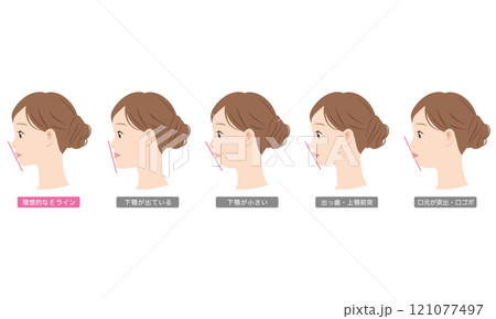 Eラインの種類 横顔 顎 下顎前突症 口ゴボ Eラインの種類 横顔 顎 下顎前突症 口ゴボ 121077497