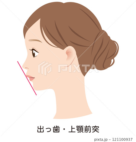 上顎突出の口元　出っ歯　Eライン　横顔 121100937