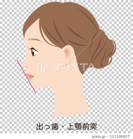 上顎突出の口元　出っ歯　Eライン　横顔 121100937
