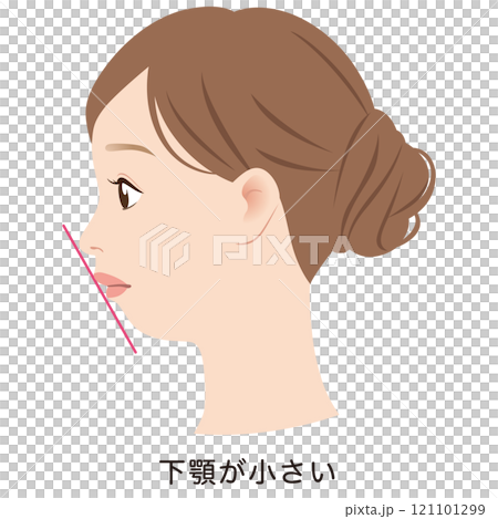 Small lower jaw, adenoid face, E-line, profile 121101299