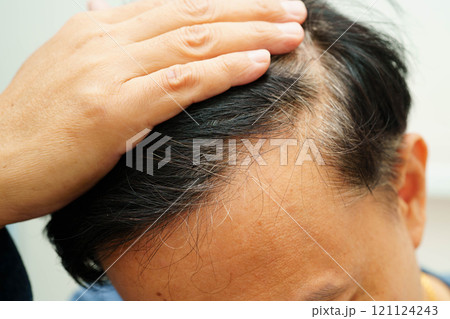 Bald head in man, hair loss treatment health problem. Bald head in man, hair loss treatment health problem. 121124243