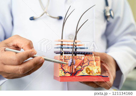 Hair transplant, Asian dermatologist doctor holding skin structure anatomy model for treatment in hospital. Hair transplant, Asian dermatologist doctor holding skin structure anatomy model for treatment in hospital. 121134160